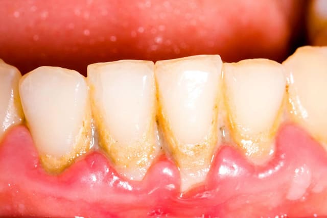 虫歯や治療した詰め物や被せ物が原因の場合