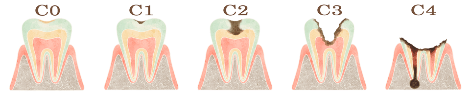 虫歯の進行度合